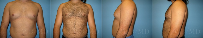 This image has an empty alt attribute its file name is malebreastreduction Jpg | william bruno plastic surgery